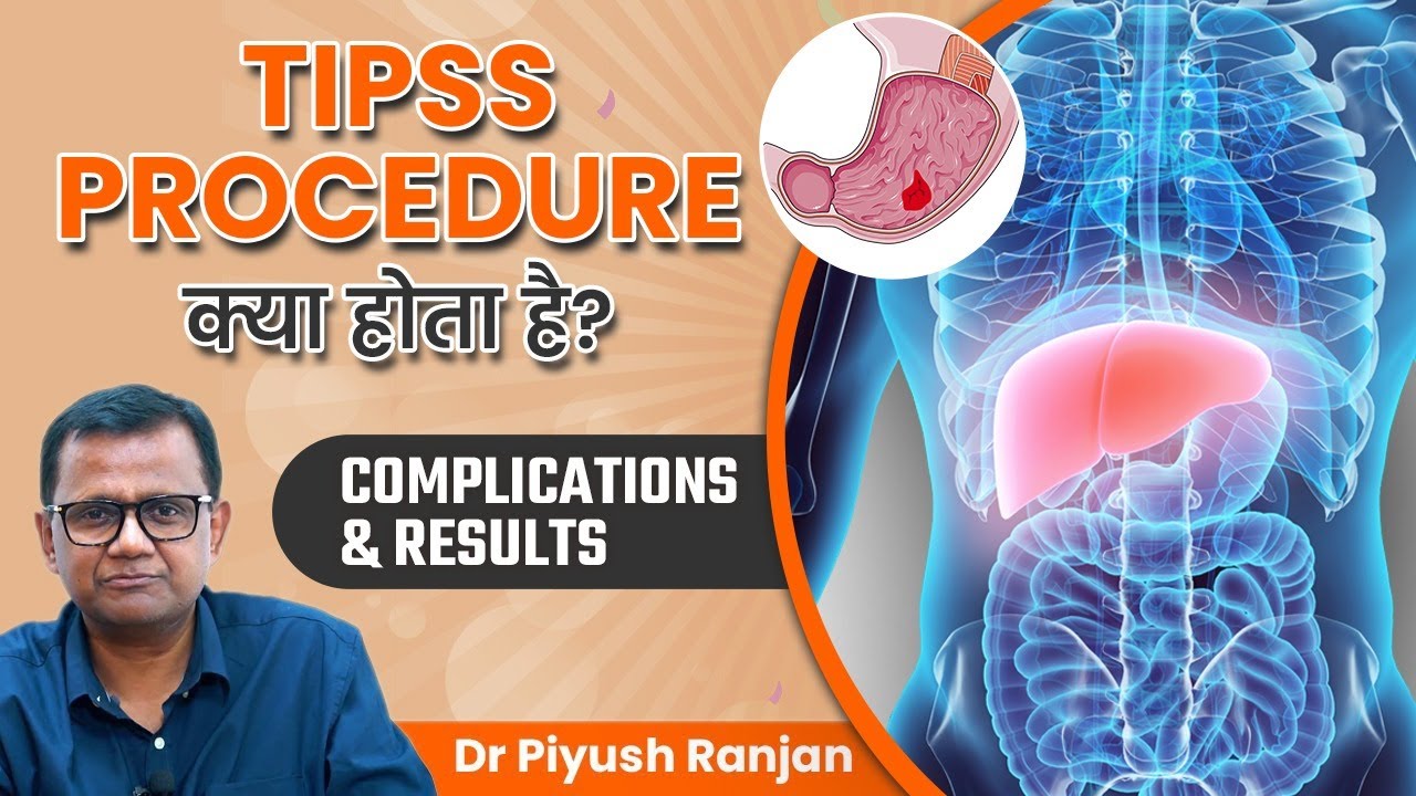 TIPSS Procedure क्या होता है? | TIPS Complications and Results? | Dr. Piyush Ranjan