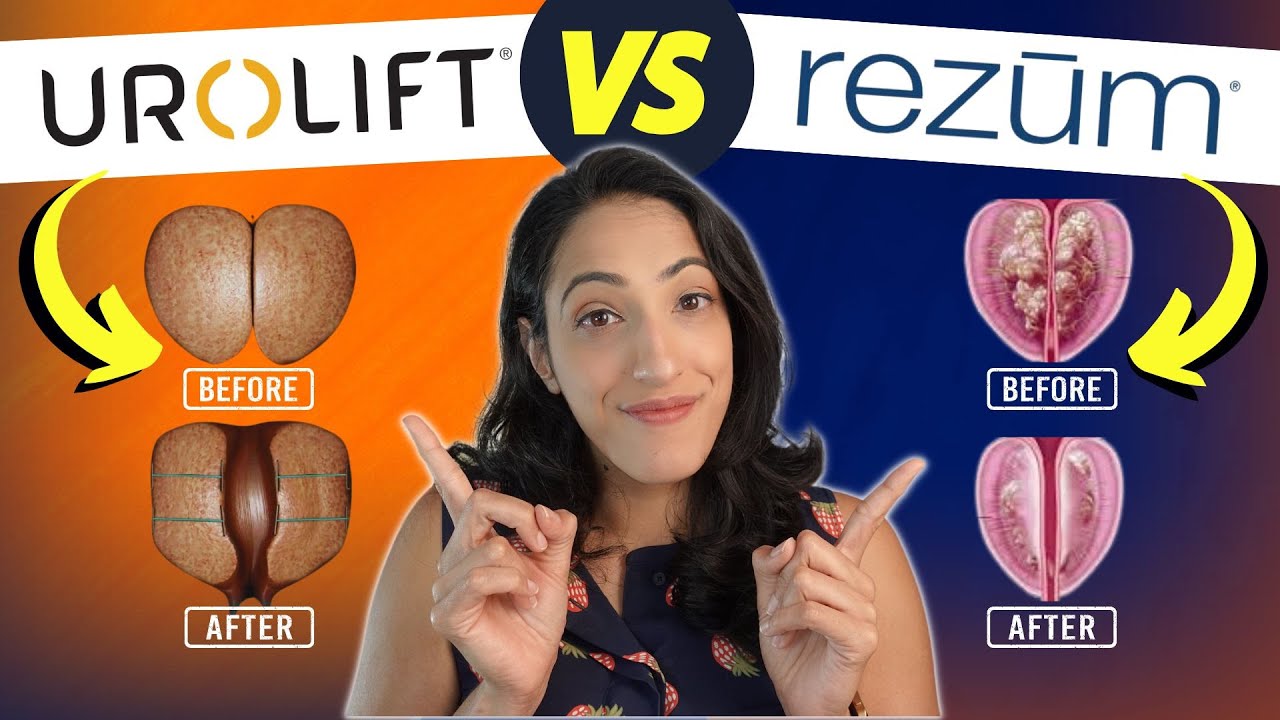 Enlarged Prostate Treatments That Won&rsquo;t Impact Your Sex Life? | Rezum vs Urolift
