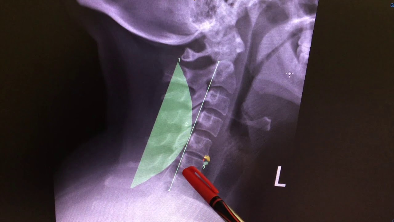 Cervical (Neck) X-Ray: Degenerative Disc, Bone Spurs and Neural Foraminal Narrowing (Radiculopathy)