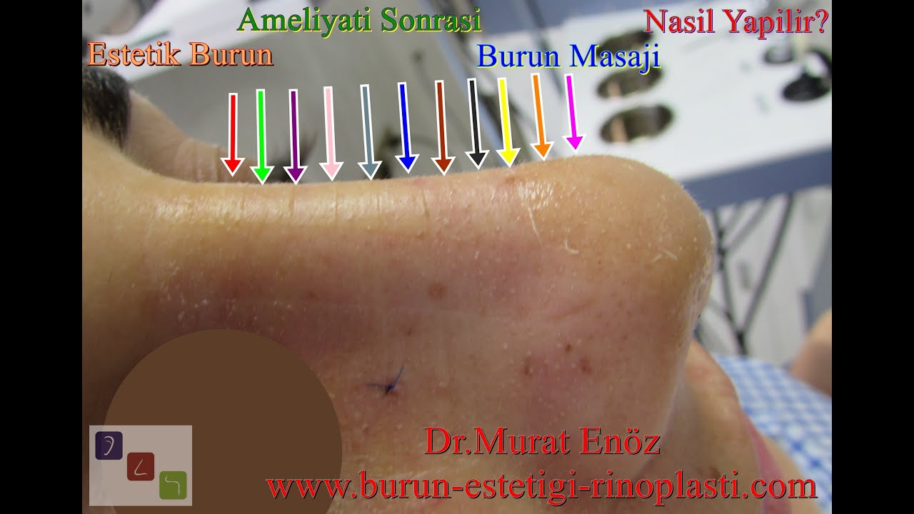 Estetik Burun Ameliyatı Sonrasında Burun Masajı Nasıl Yapılır?