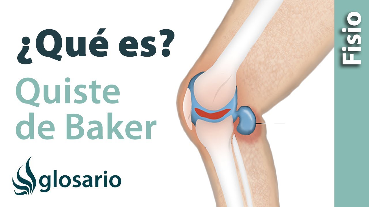 QUISTE DE BAKER | ¿Qué es?