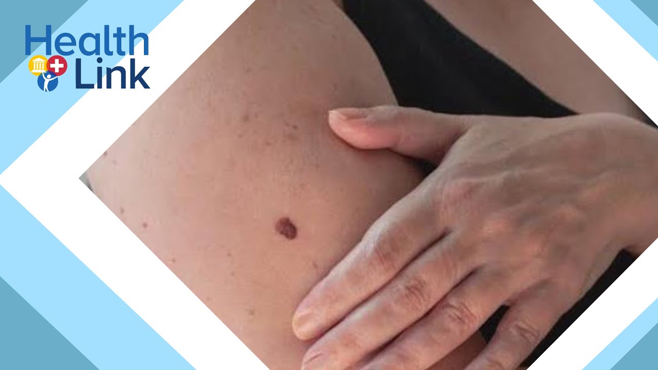 What to know about skin cancer risks: HealthLink