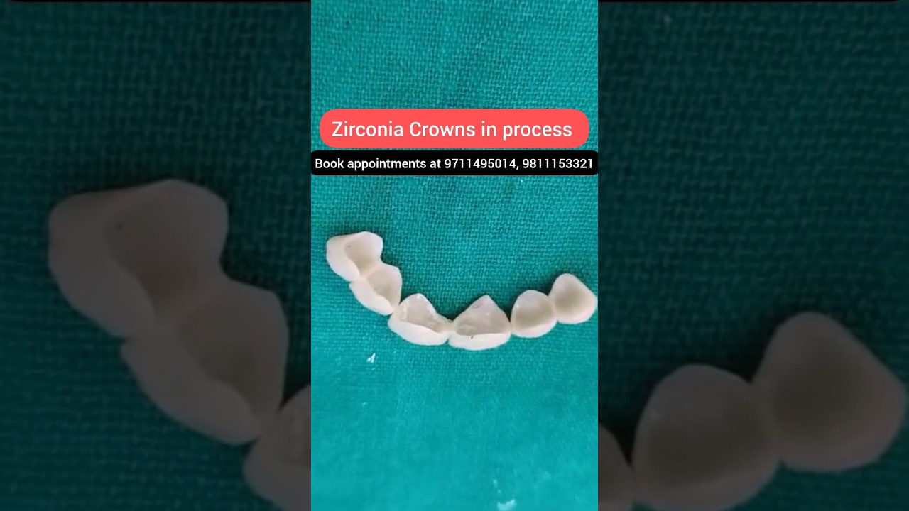 Zirconia Crowns for Front Teeth in Process; Dr. Srishti Bhatia 