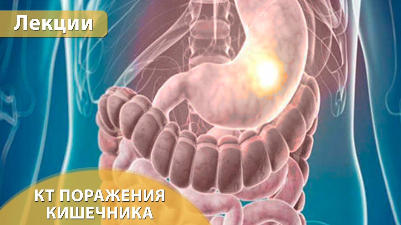 Часть 3. КТ поражений кишечника - аппендицит, дивертикулит, аппендагит. Андрей Мангов