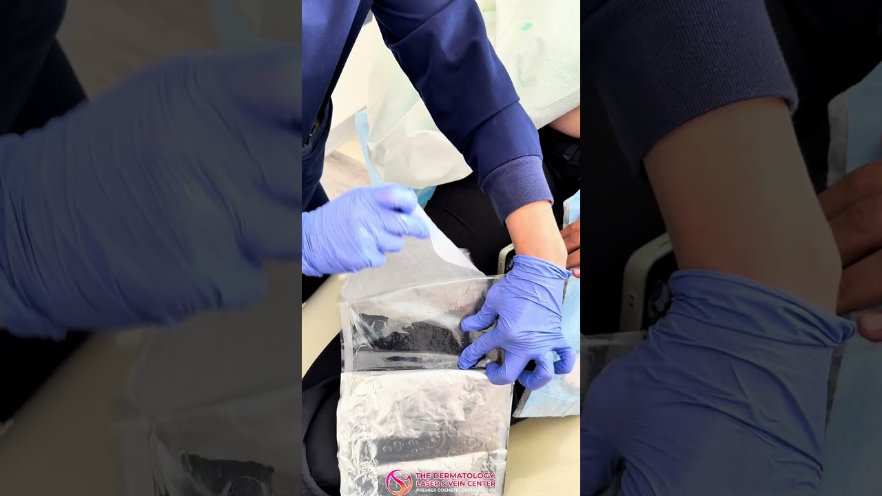 Targeted Arm Fat Reduction with CoolSculpting | Real Treatment #cincinnati #skintreatment