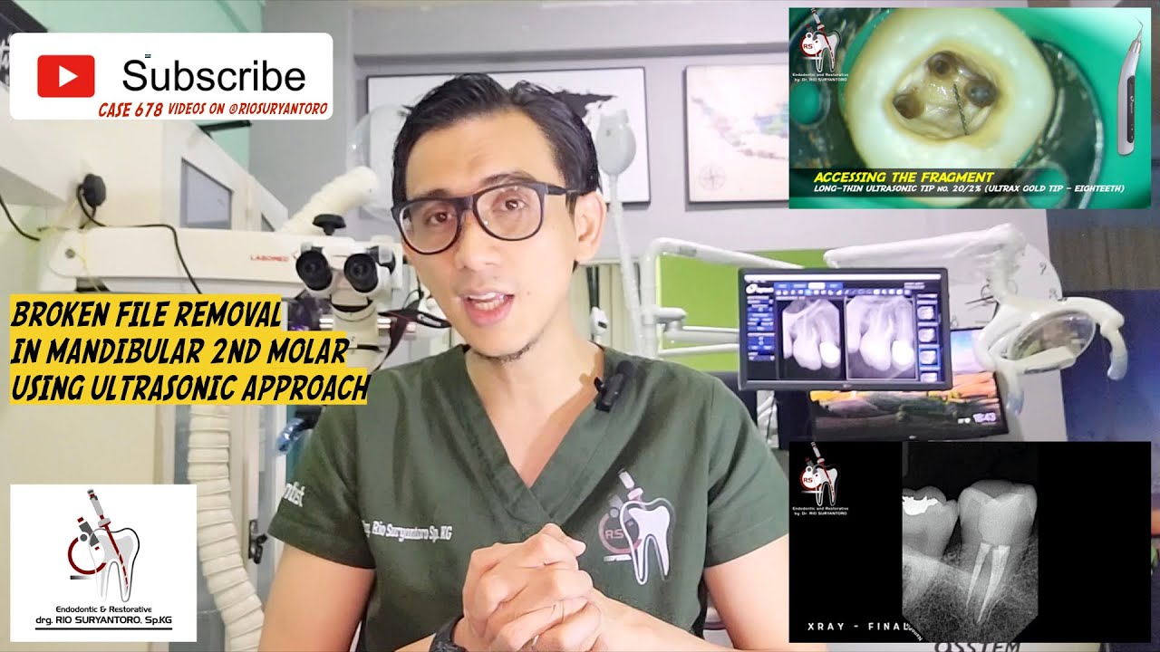 BROKEN ENDODONTIC FILE REMOVAL IN MANDIBULAR 2ND MOLAR USING ULTRASONIC APPROACH - ONE VISIT ENDO 🦷