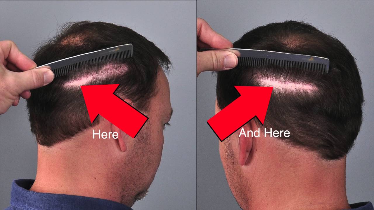 Beard FUE Into Donor Scar in 4K Ultra HD