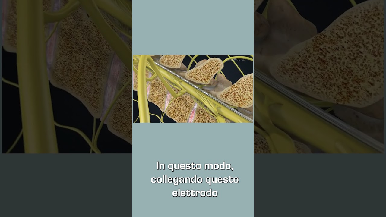 Neurostimolazione del midollo spinale - Dott. Antonio Musio #neurochirurgo #dolorecronico