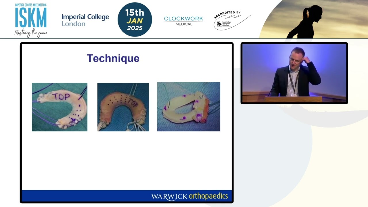 Meniscal Allograft Transplantation – Where Are We in 2025? | Nick Smith