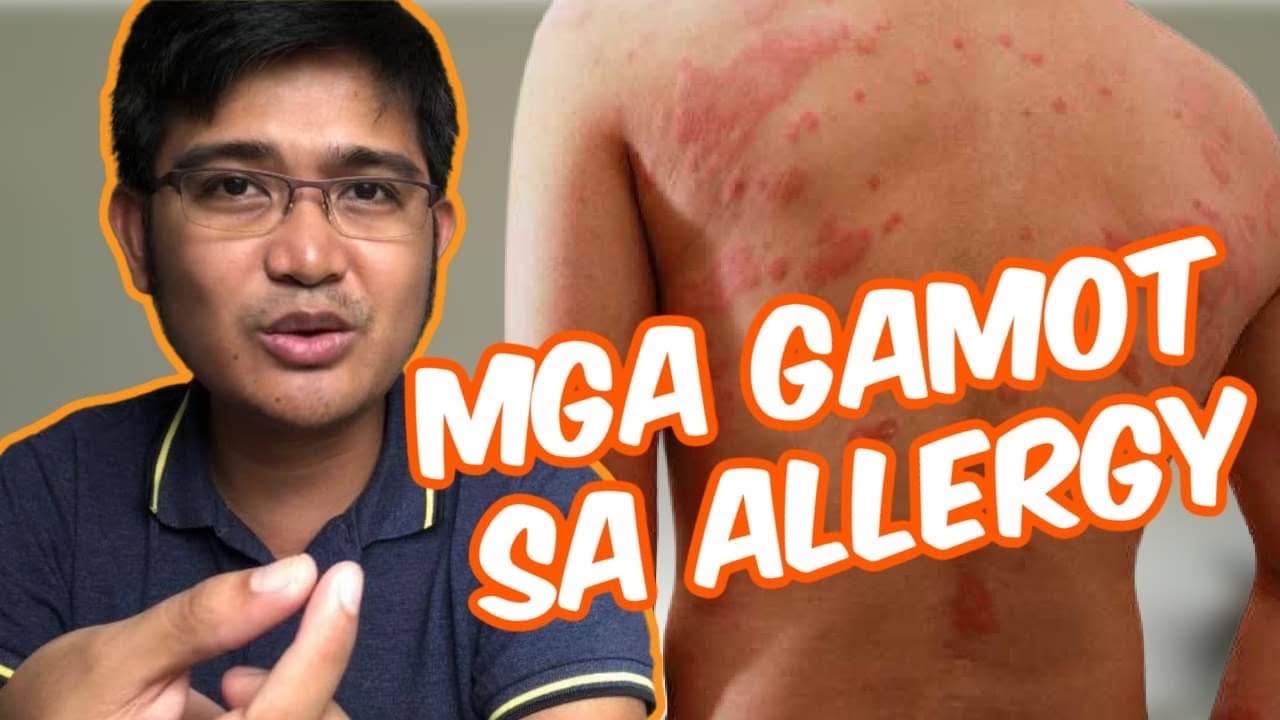 GAMOT PARA SA ALLERGY AT KATI | RENZ MARION