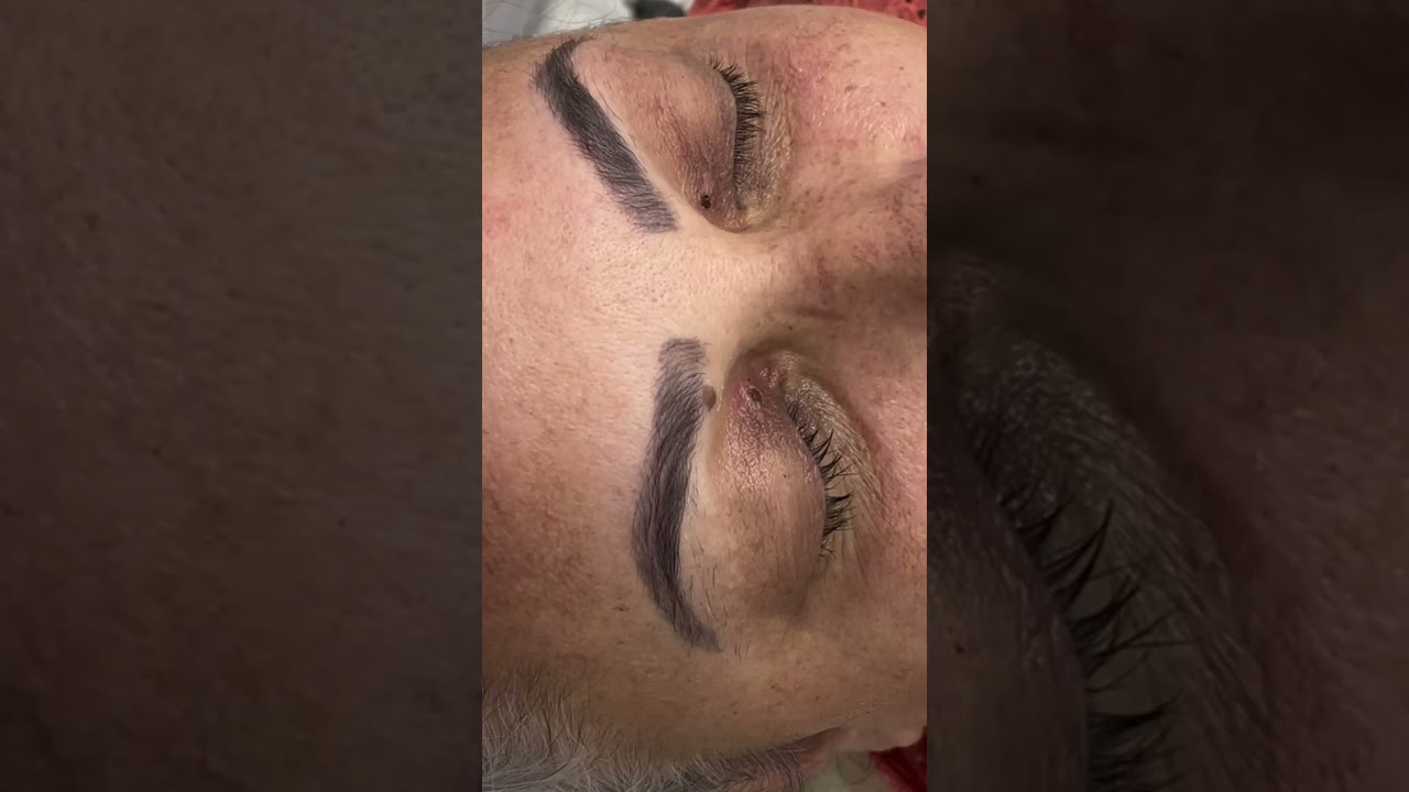 Xantelasma não tem vez com Jato de plasma!#jatodeplasma #xantelasma #esteticafacial #estetica