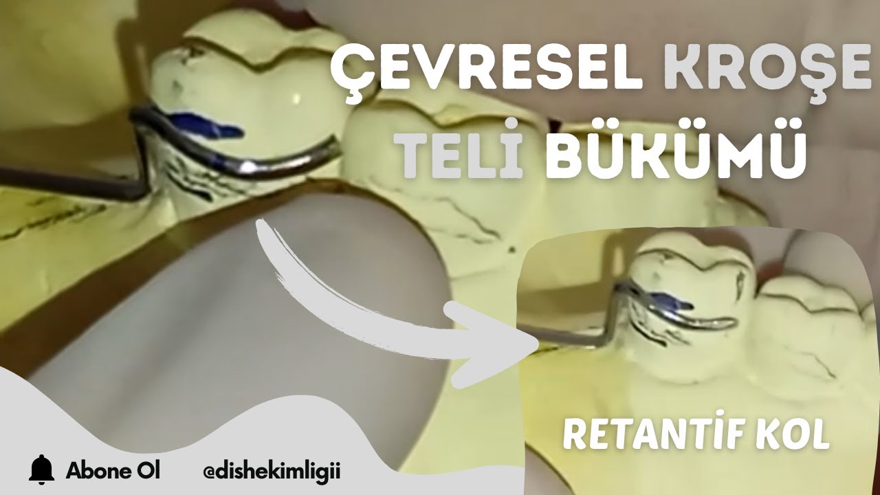 Çevresel Kroşe Bükümü- Retantif Kroşe Kolu