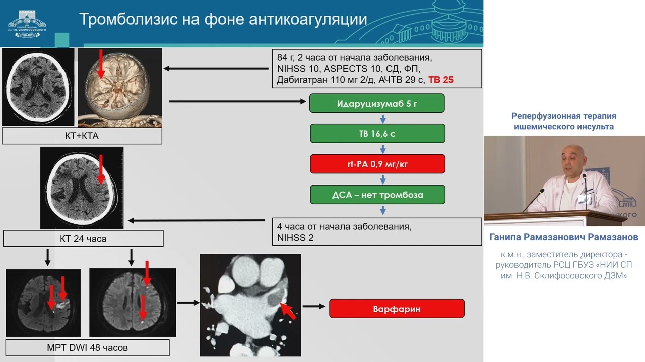 Реперфузионная терапия ишим инсульта Рамазанов Г.Р.