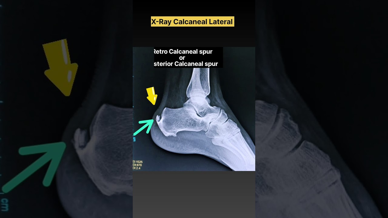 Retro Calcaneal spur | Heel spur #xray #shorts #radiography #radiology