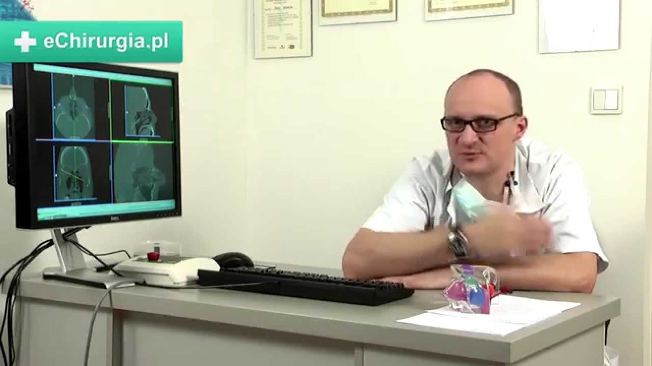 Jak wygląda koblacja?
