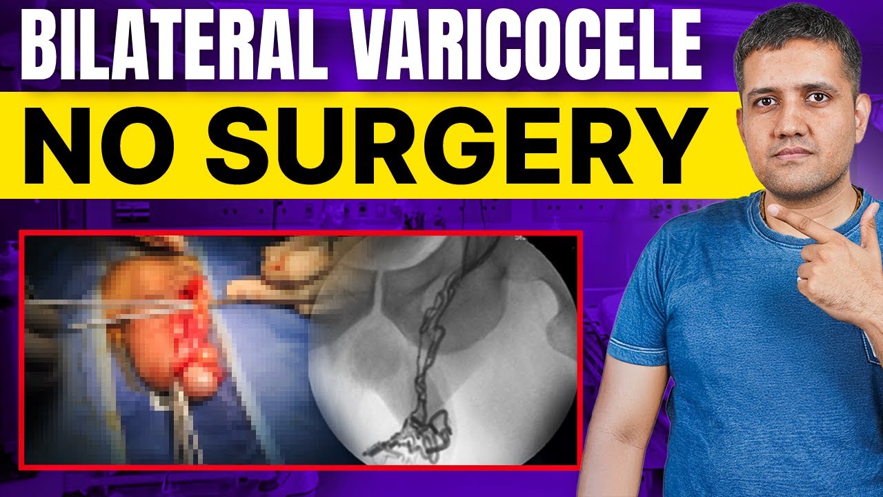99% Success for Testicular Problems | Bilateral Varicocele Embolization | Dr. Gaurav Gangwani