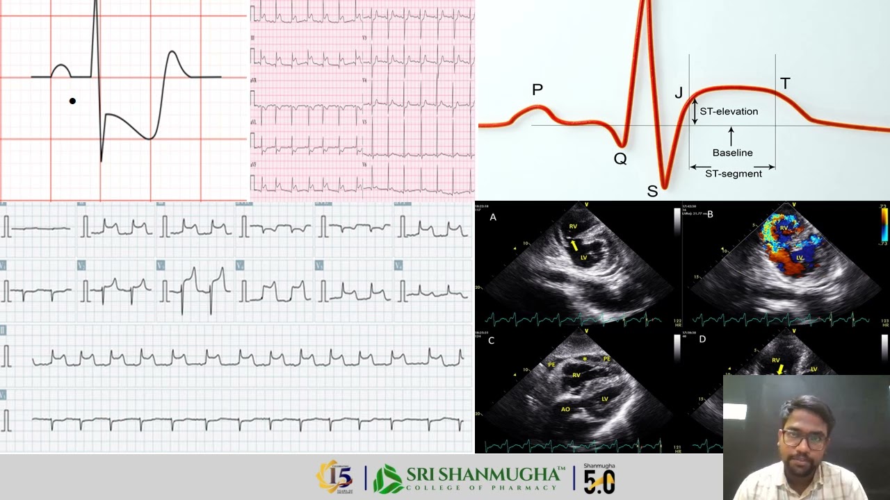 Myocardial Infarction   Diagnosis & Pathophysiology