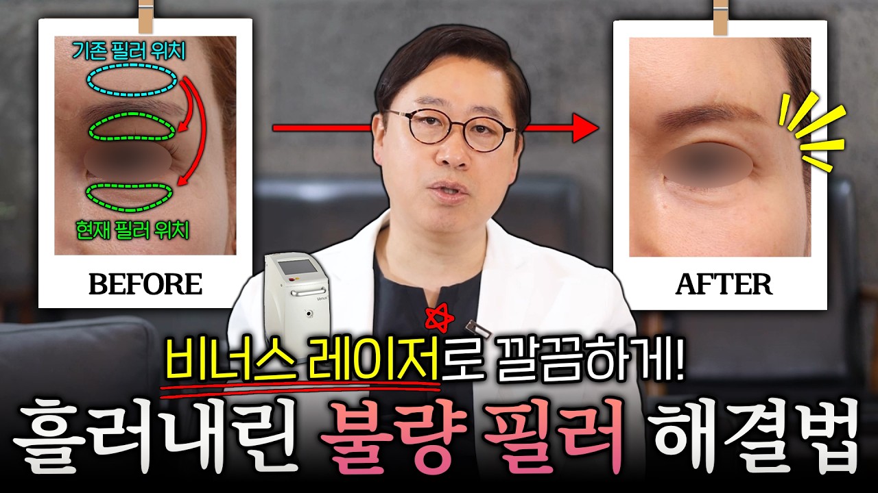 절대 안 녹는 필러가 있다?! 눈 밑까지 내려온 필러 덩어리 제거 리얼 후기