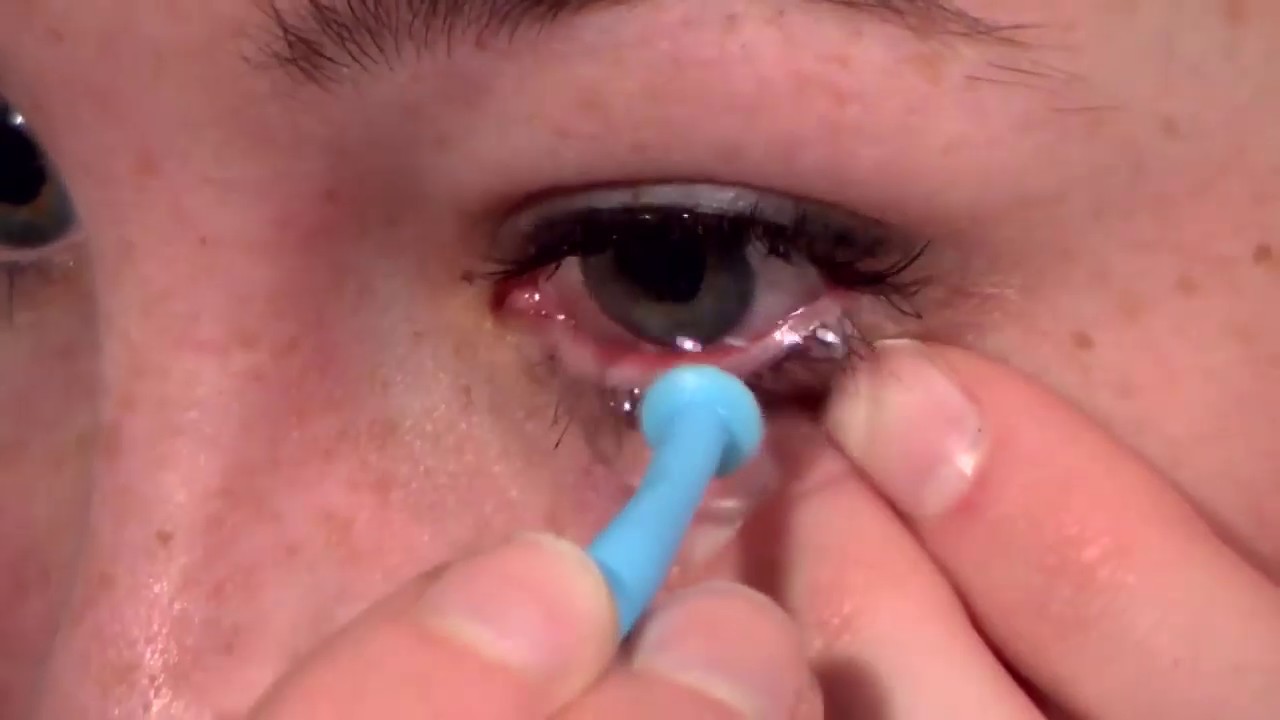 CK Optik-Scleral lens