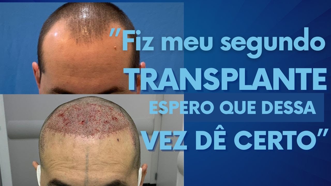 Transplante Capilar: Histórias de Sucesso e Fracasso na Clínica Padrão Ouro