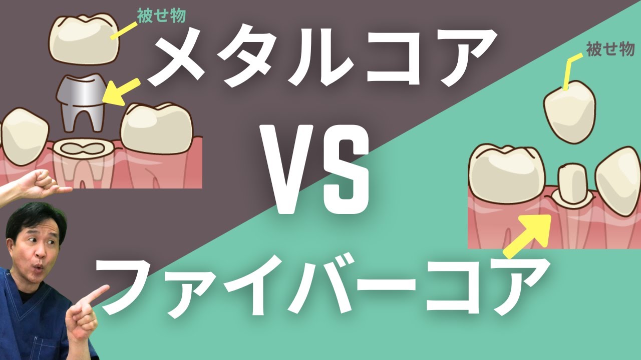 【メタルコア VS ファイバーコア】どっちがいいの？歯医者がわかりやすく解説