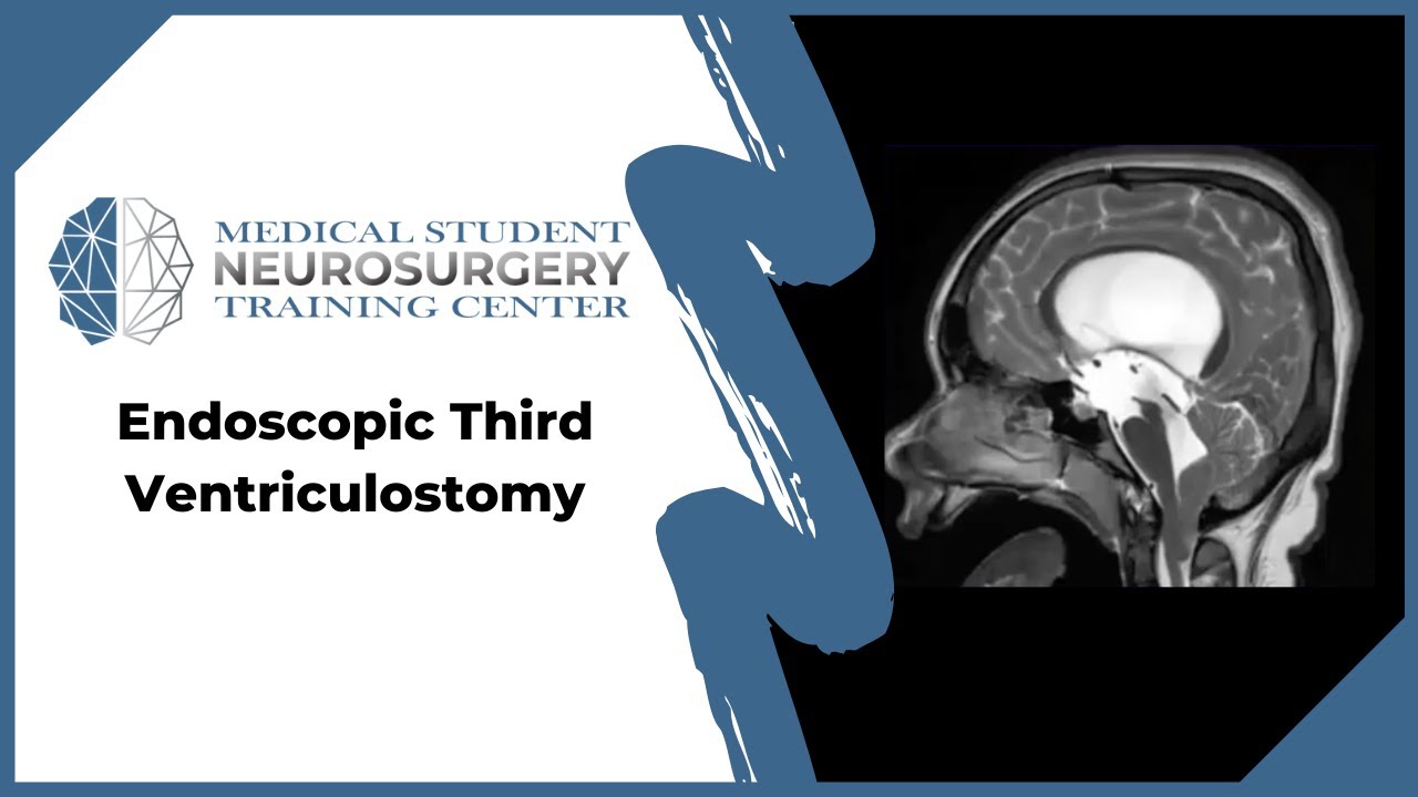 Endoscopopic Third Ventriculostomy