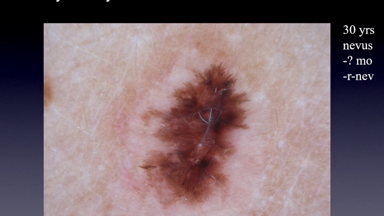 Recurrent nevus or melanoma - Dr. Andreas Blum