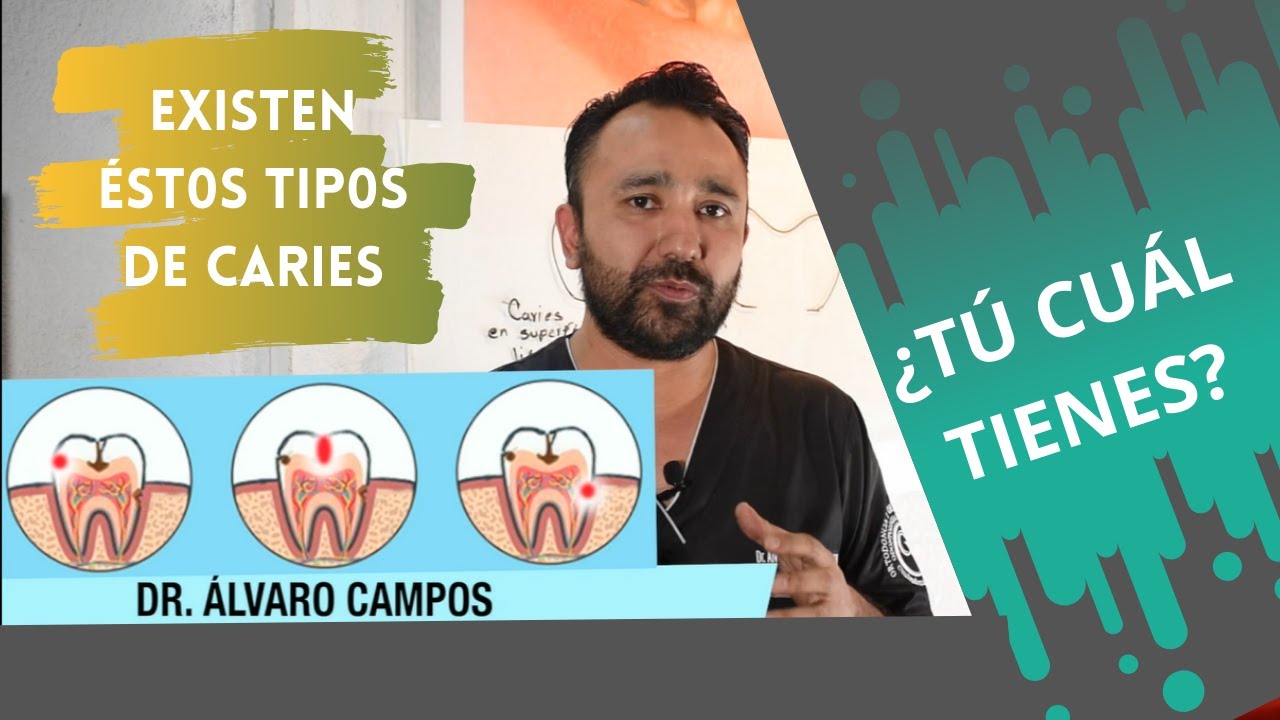 ¿Qué tipos de caries existen?  | Dr. Alvaro Campos