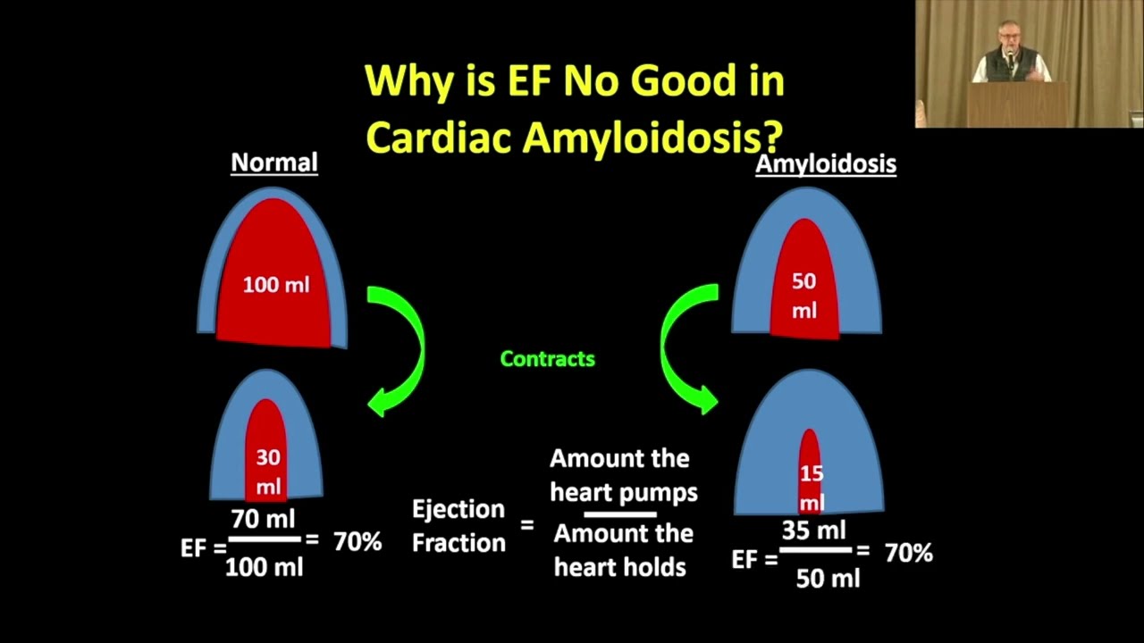 ATTR Cardiac Amyloidosis: Treating the Symptoms
