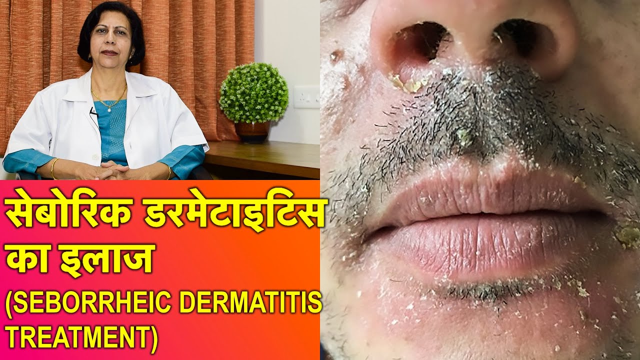सेबोरिक डर्मेटाइटिस और डैंड्रफ का ईलाज || Dandruff & Seborrheic Dermatitis Treatment