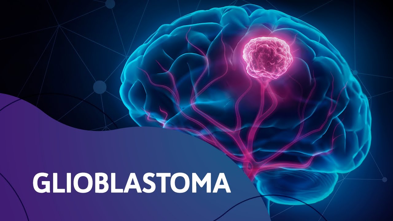 Glioblastoma