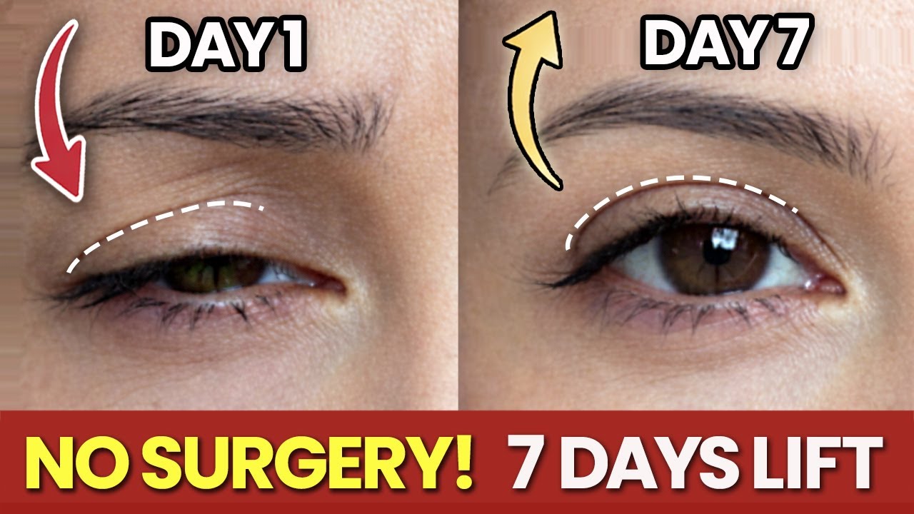 Fix Droopy Eyelids Naturally in 7 Days | No Surgery Eye Lift