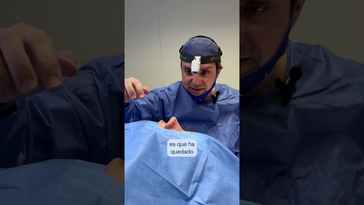 Rinoplastia ultras&oacute;nica: Antes y Despu&eacute;s