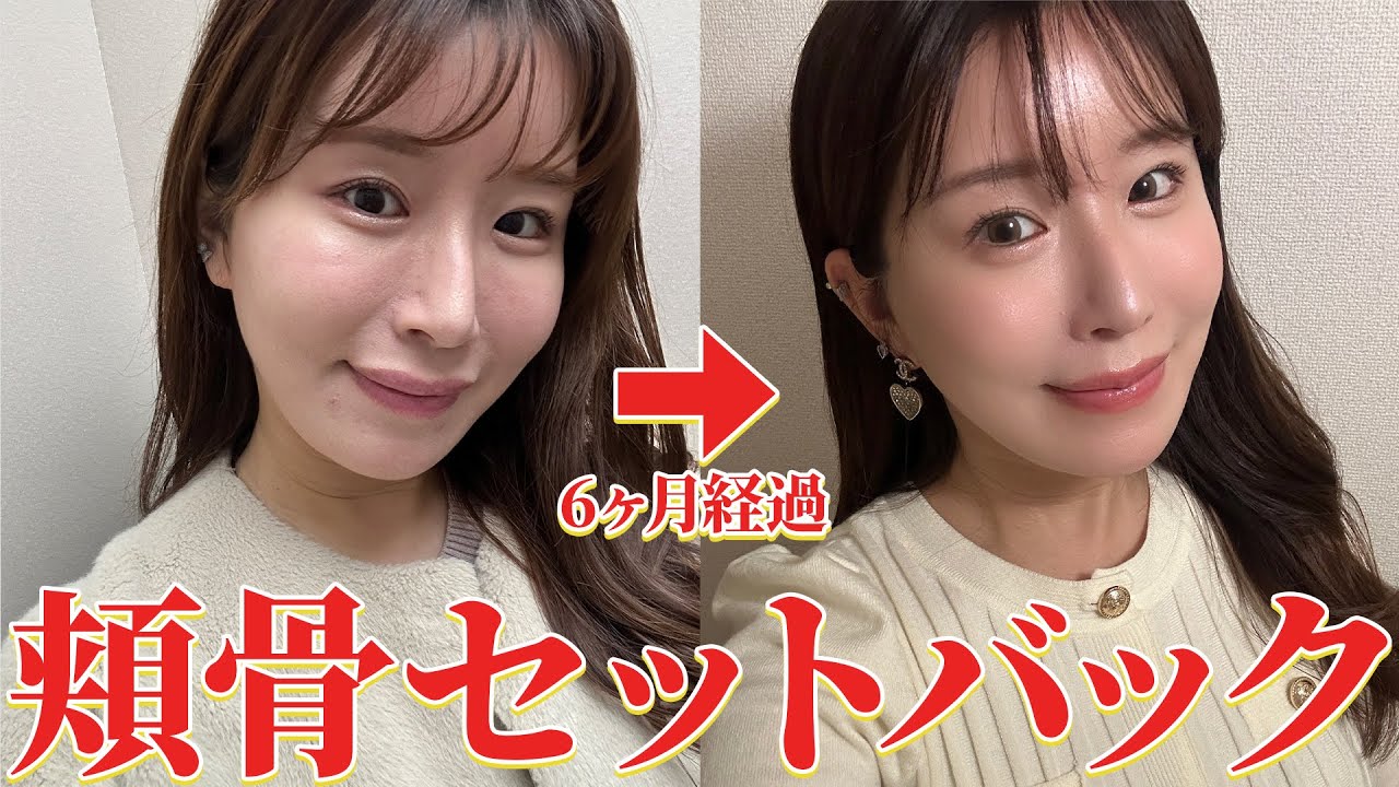 【整形】頬骨セットバック半年が経過しました！ビフォーアフター公開【輪郭整形】