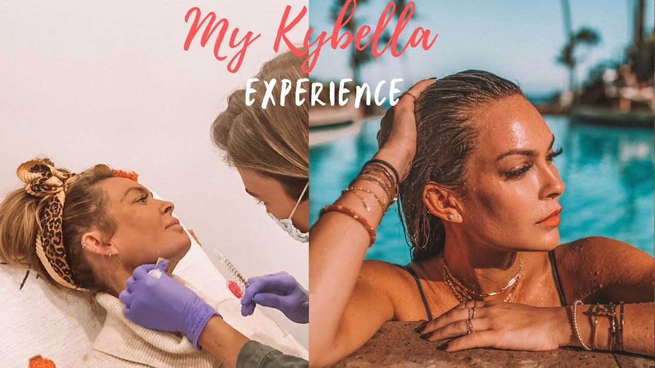 My Kybella experience -Before and After 2 kybella treatments