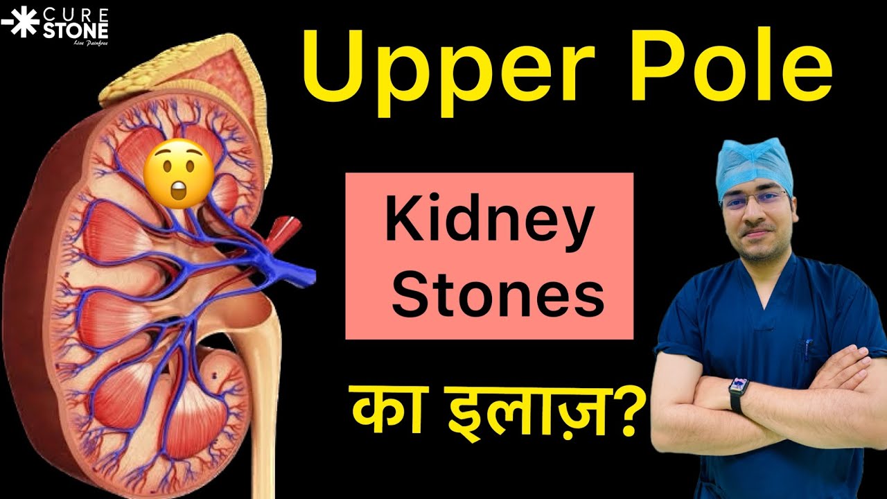 Upper Pole में Kidney Stones कैसे निकालें | Kidney Stones In Upper Pole : How do we remove it? #rirs