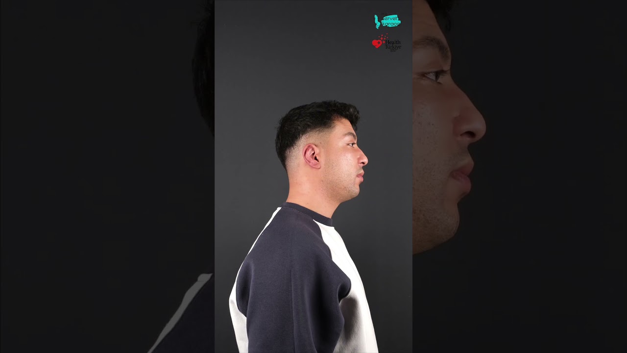Revizyon Otoplasti/ Ameliyat Sonrası Doğal ve Simetrik Kulak Yapısı 👂🏻#shorts