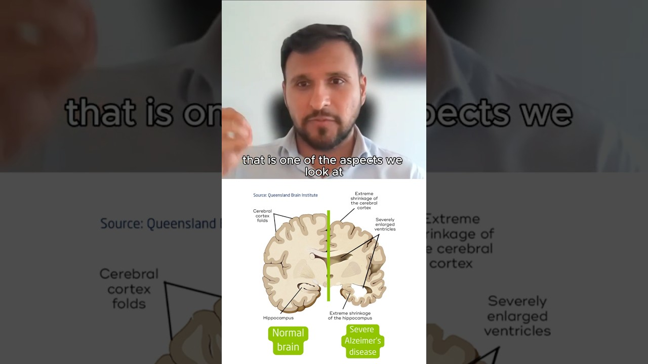 Brain atrophy & dementia  #brainhealth  #dementia #ageing #neuroscience #science