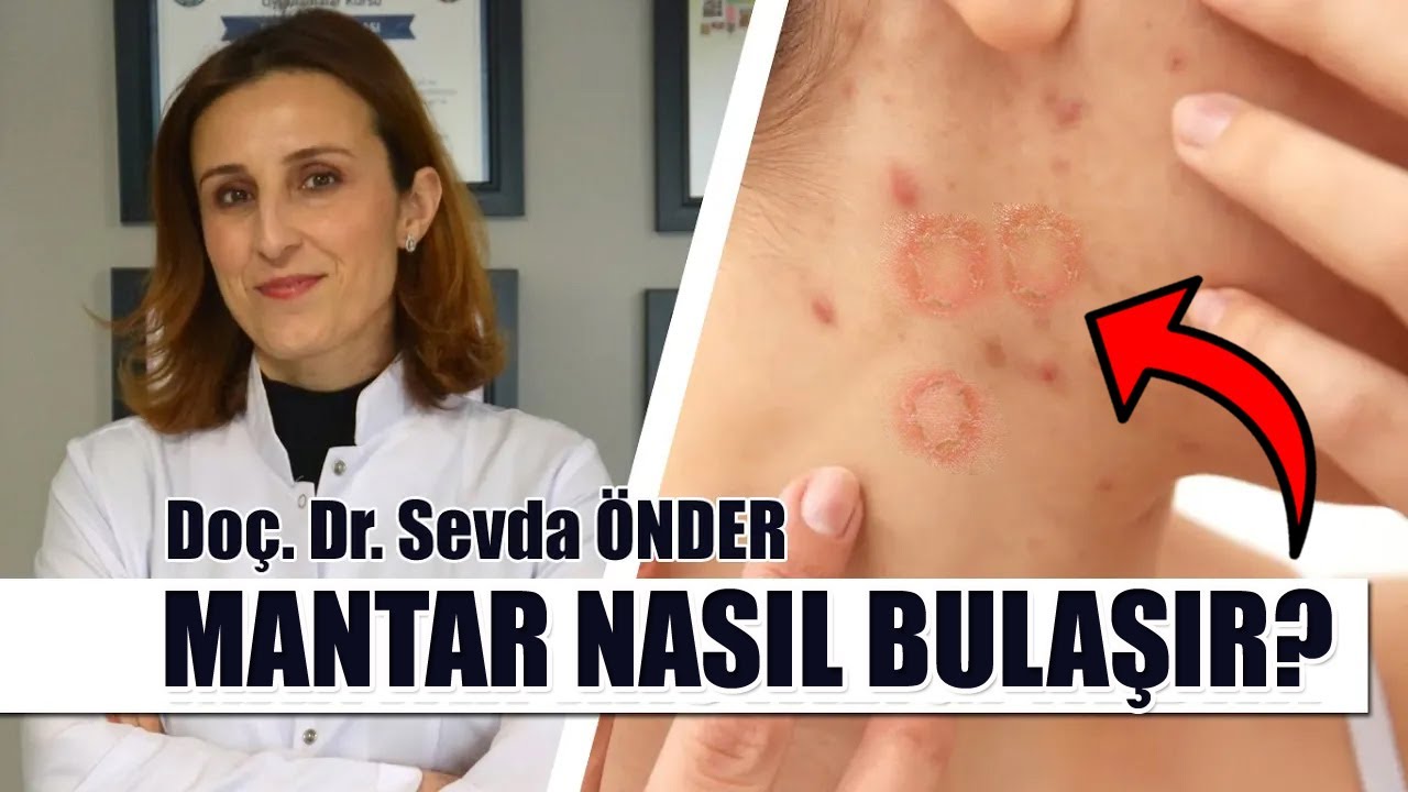 Mantar Hastalığı Nedir? | Mantar bulaşıcı mıdır? | Mantar hastalığının tedavisi nasıl yapılır?