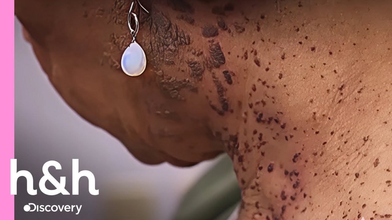 La doctora Lee atiende caso extremo de Queratosis seborreica | Dra. Sandra Lee: Especialista en Piel
