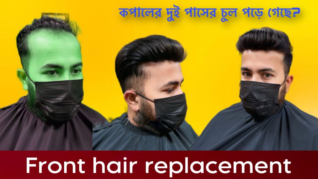 ফ্রন্টে হেয়ার রিপ্লেসমেন্ট | non surgical hair replacement in farmgate | kopaler hair patch