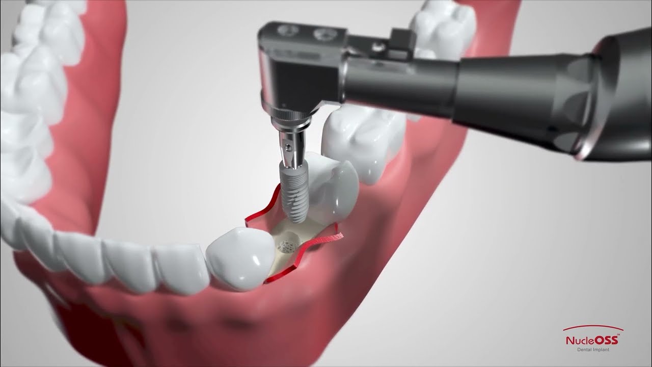 NucleOSS T6 Implant Surgery