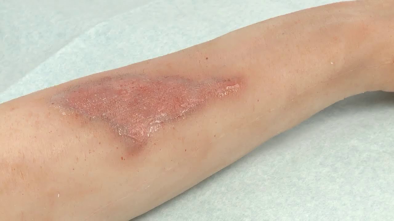 How to apply Mepitel®