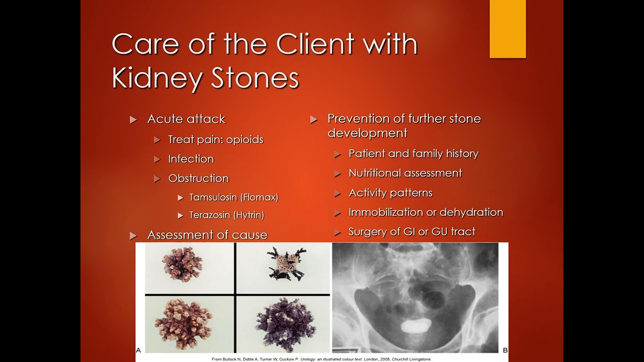 Medical/Surgical Nursing: Renal Calculi