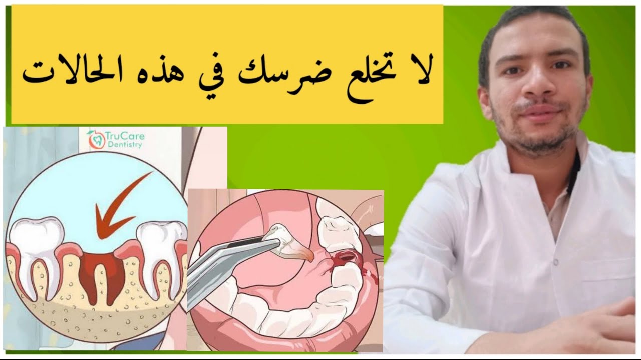 ممنوع خلع الضرس في هذه الحالات