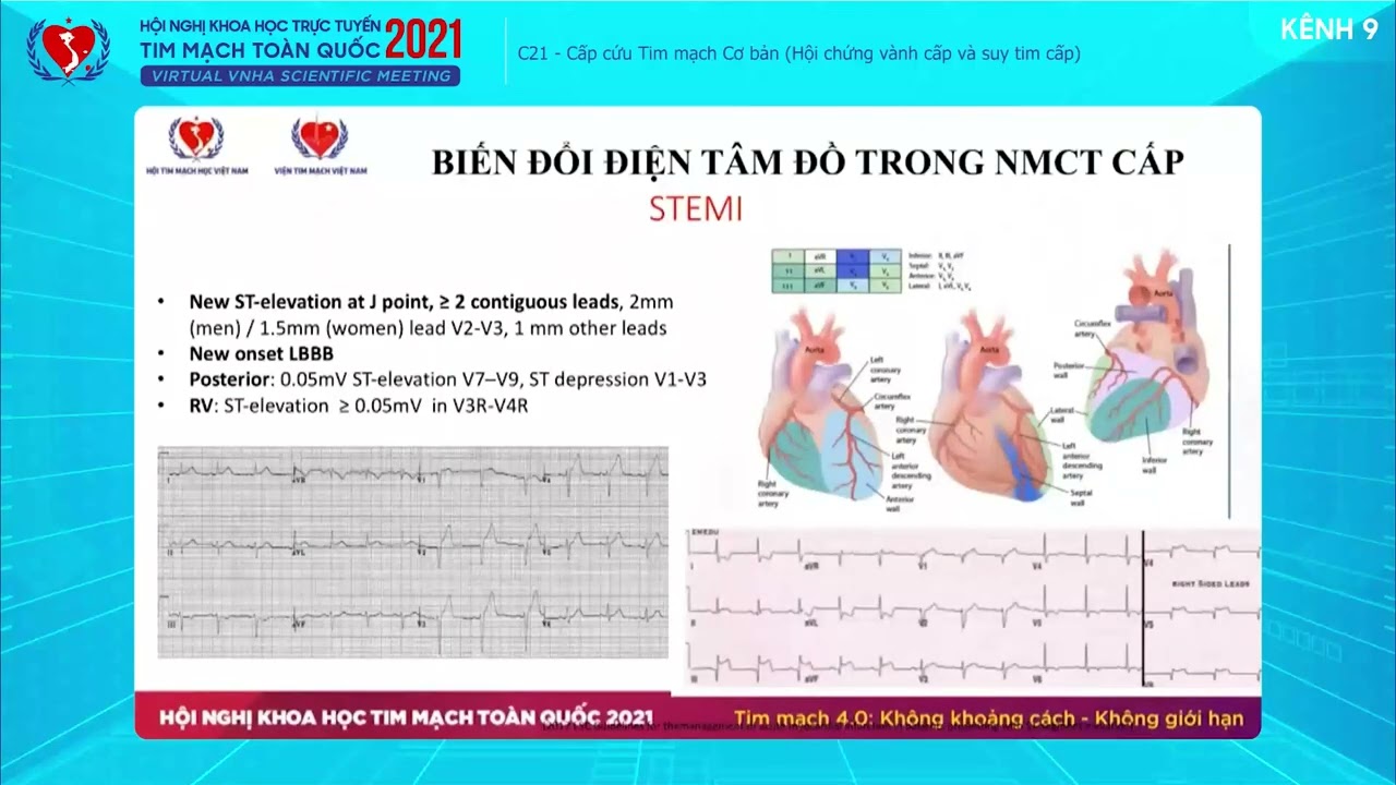 TS. Vũ Quang Ngọc - Chẩn đoán và xử trí NMCT cấp