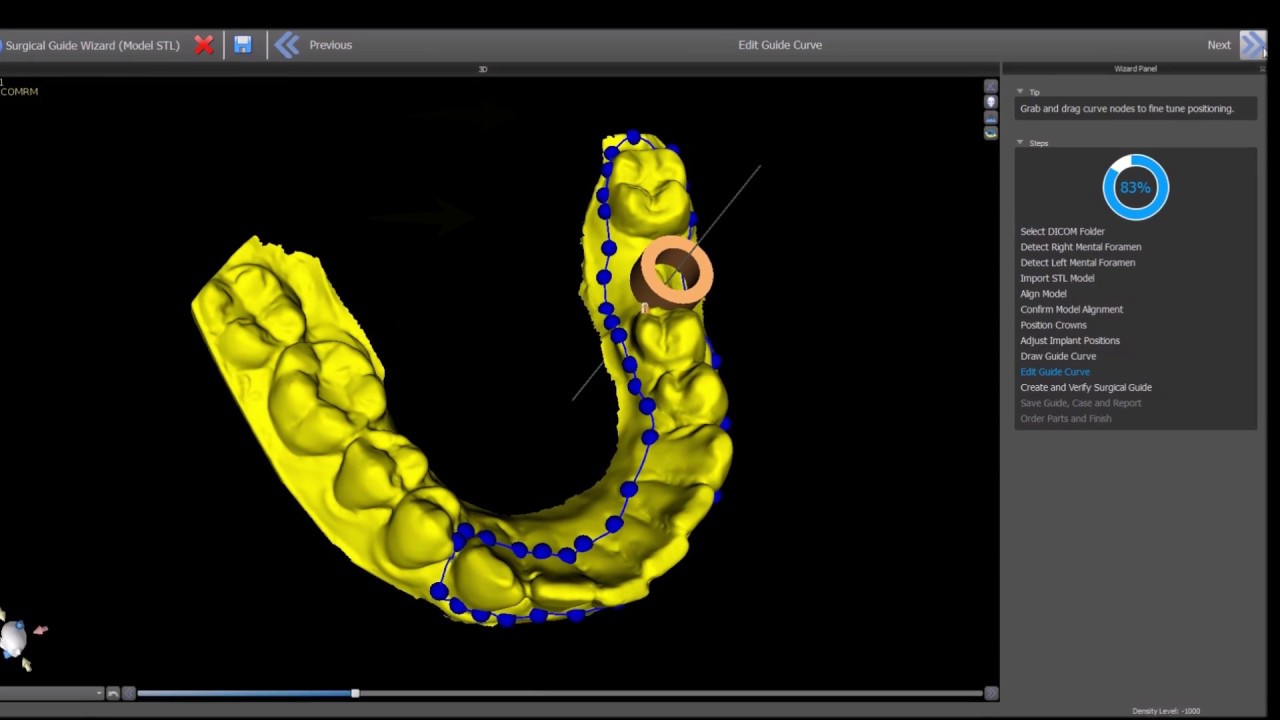 Complete Step by Step Process Flow For Patient CT and Model STL