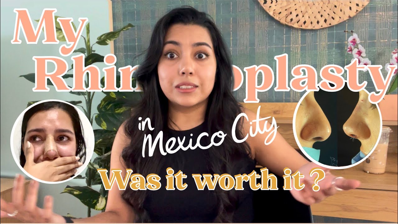 My Rhinoplasty Experience in Mexico | Was it worth it? | Will I need a revision?