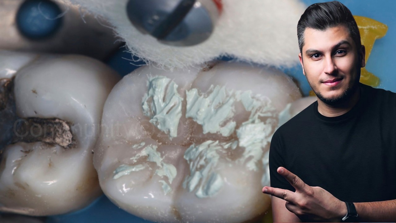 الحشوات التجميلية كما يجب ان تكون شرح حالة من حالات دكتور محمد الحسني 🇮🇶