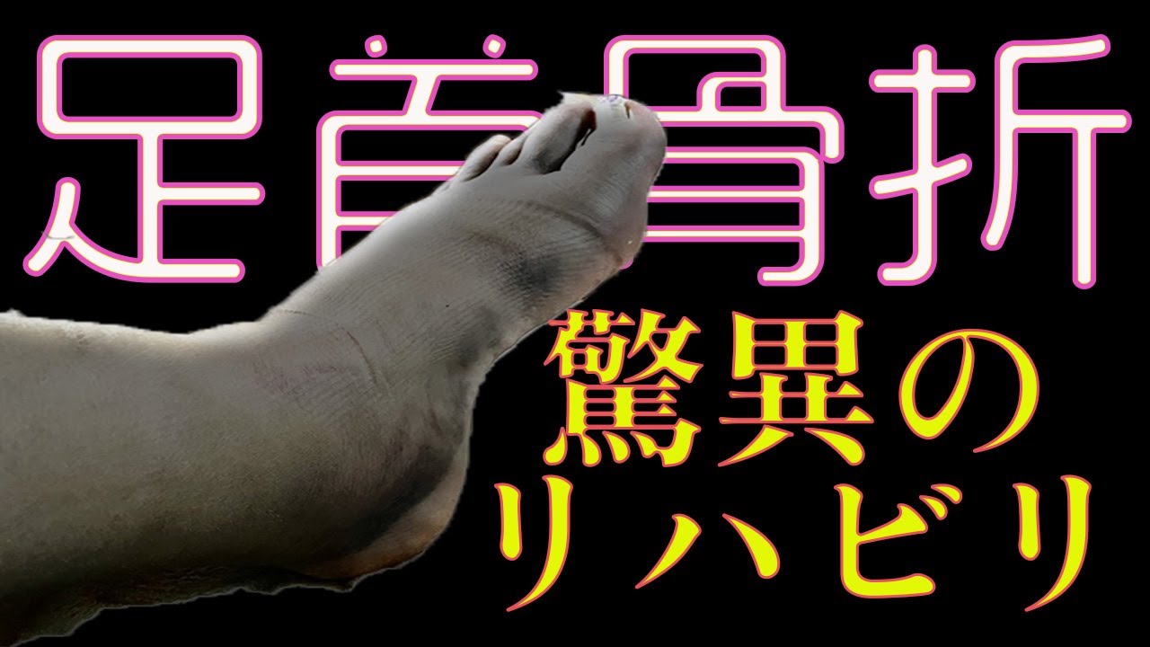 足首骨折 最も不運方の足首周辺骨折のその後とは？
